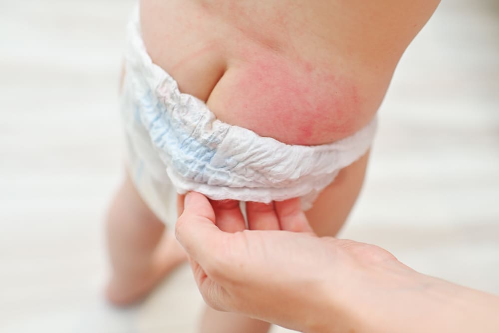 Nói “không” với hăm tã cho bé, mẹ bỉm đã biết cách?